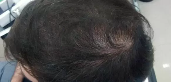 DEPOIS - Resultado Tratamento Queda de Cabelo e Calvície