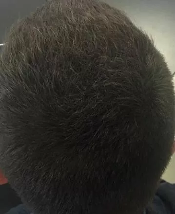 DEPOIS - Resultado Tratamento Queda de Cabelo e Calvície