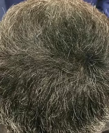 DEPOIS - Resultado Tratamento Queda de Cabelo e Calvície