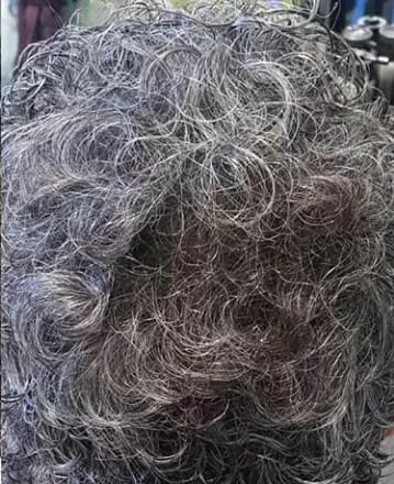 DEPOIS - Resultado Tratamento Queda de Cabelo e Calvície
