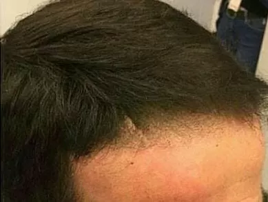 DEPOIS - Resultado Tratamento Queda de Cabelo e Calvície