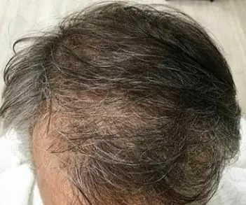 DEPOIS - Resultado Tratamento Queda de Cabelo e Calvície