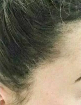 DEPOIS - Resultado Tratamento Queda de Cabelo e Calvície