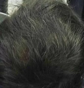 DEPOIS - Resultado Tratamento Queda de Cabelo e Calvície