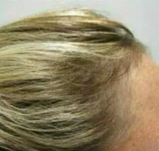 DEPOIS - Resultado Tratamento Queda de Cabelo e Calvície