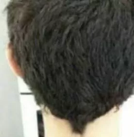 DEPOIS - Resultado Tratamento Queda de Cabelo e Calvície