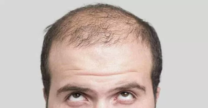 Finasterida para queda de cabelo